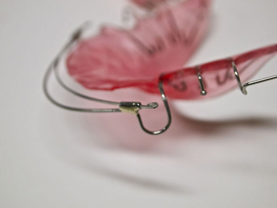 Orthodontic Appliances for Alignment ☑️ CD Ortho Studio