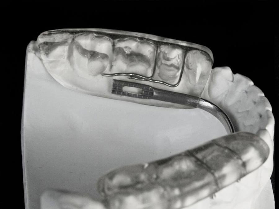 gelb splint orthodontic lab