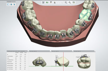 indirect bracketing dental lab