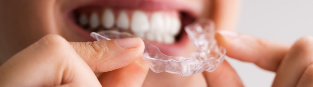 best material for clear aligners dental lab