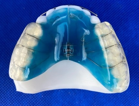 Image depicts an development indirect bracketing orthodontic appliance.