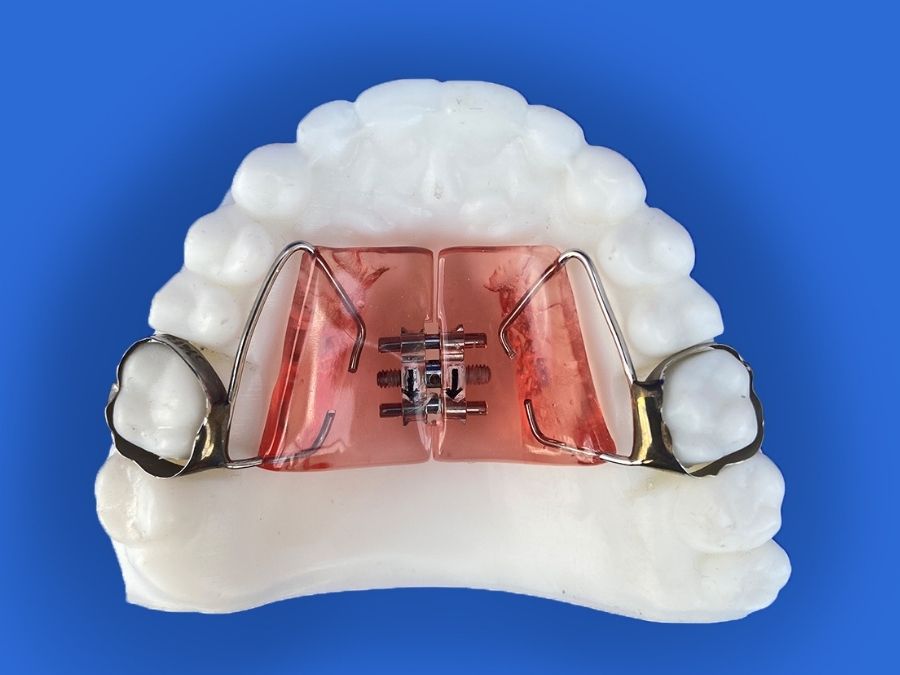 Development- Haas Palatal Expander