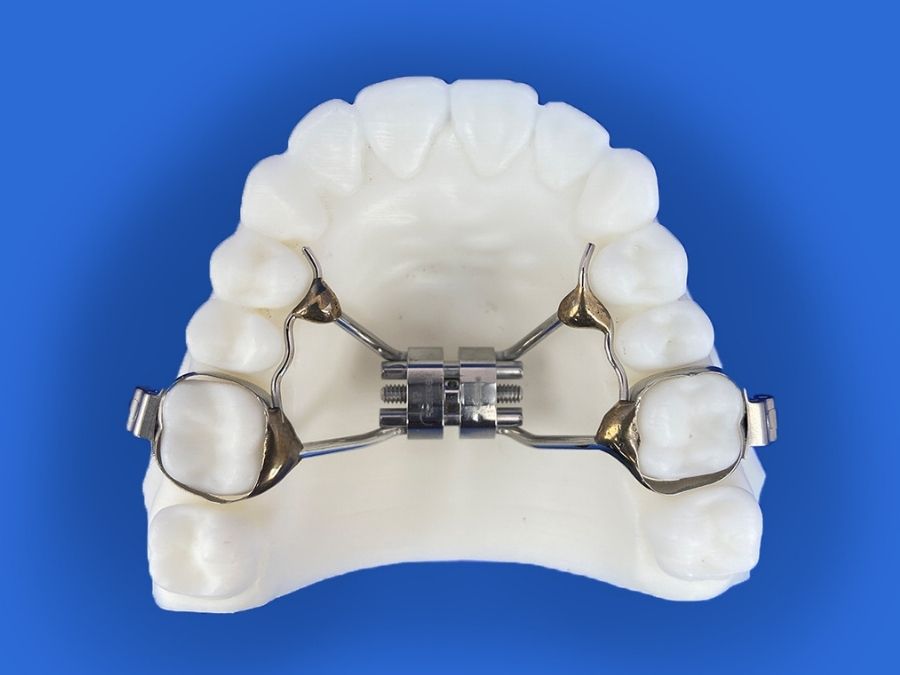 Development - palatal expander