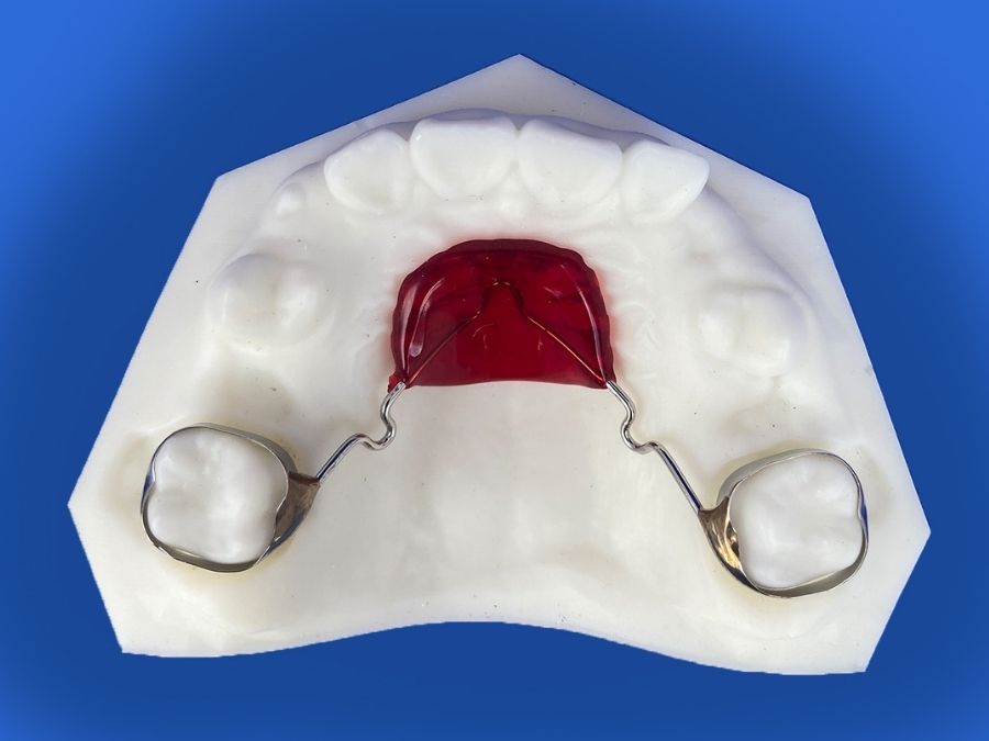 Orthodontic Appliances for Space Maintenance-Nance holding arch